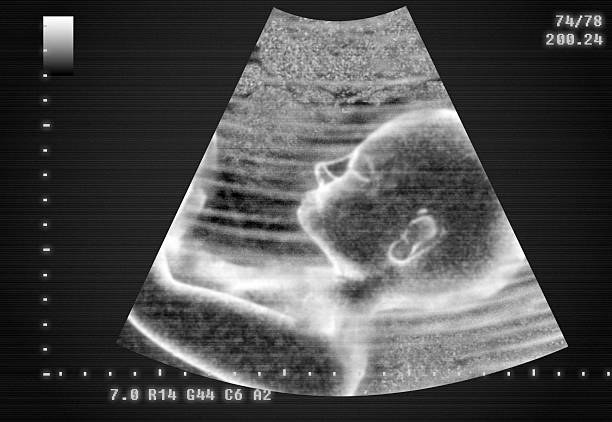 Techniques for Auscultation of Fetal Heart Tones